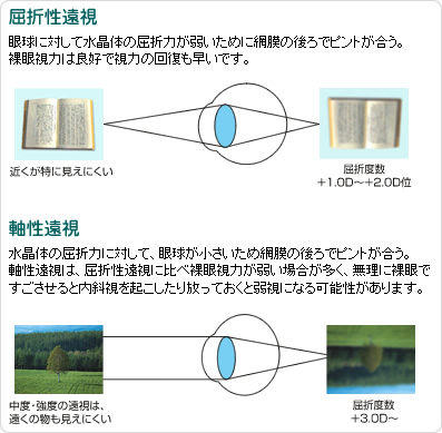 遠視について