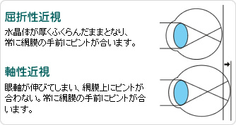 近視について