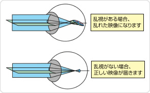 乱視について